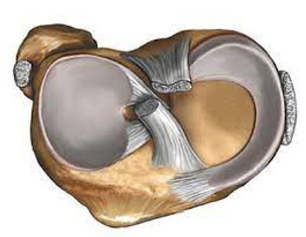 Дискоїдний меніск – вроджена аномалія менісків колінного суглоба