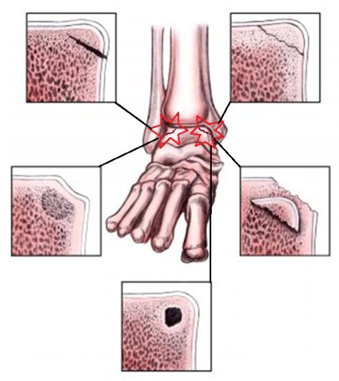 Остеохондрит таранної кістки (остеохондральні пошкодження таранної кістки). Що таке остеохондрит, причини, симптоми, діагностика, лікування, профілактика та прогноз