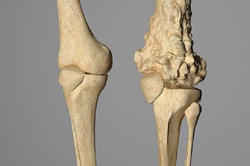 osteosarcoma